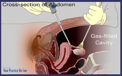 Laparoscopic Surgery